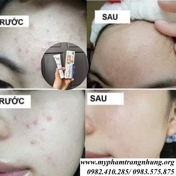gel-megaduo-15g-tri-mun-hieu-qua
